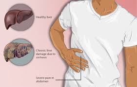 Cirrhosis