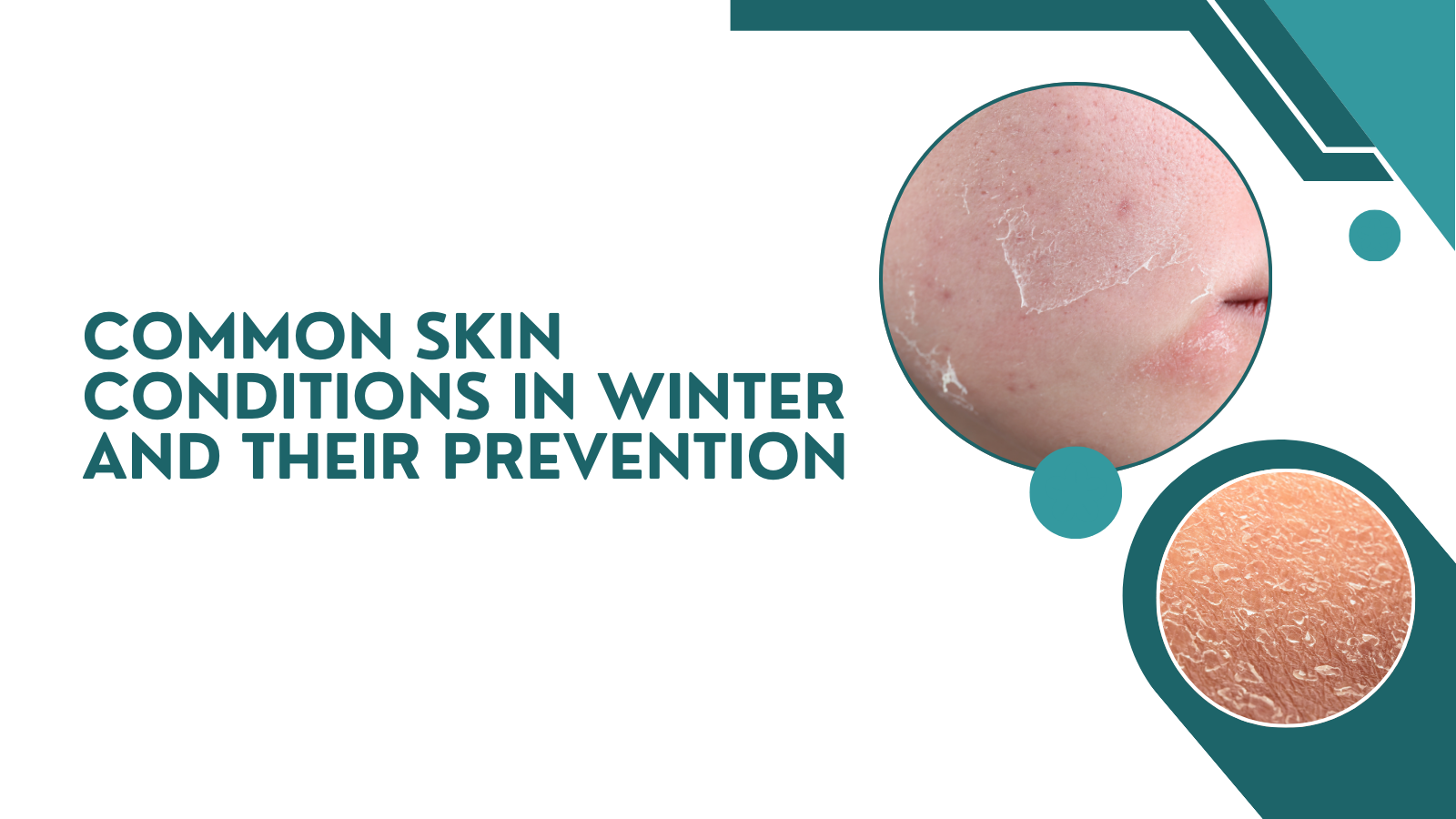Common winter skin problems like dry skin, eczema, acne, and chapped lips—learn causes, prevention tips, and skincare advice.