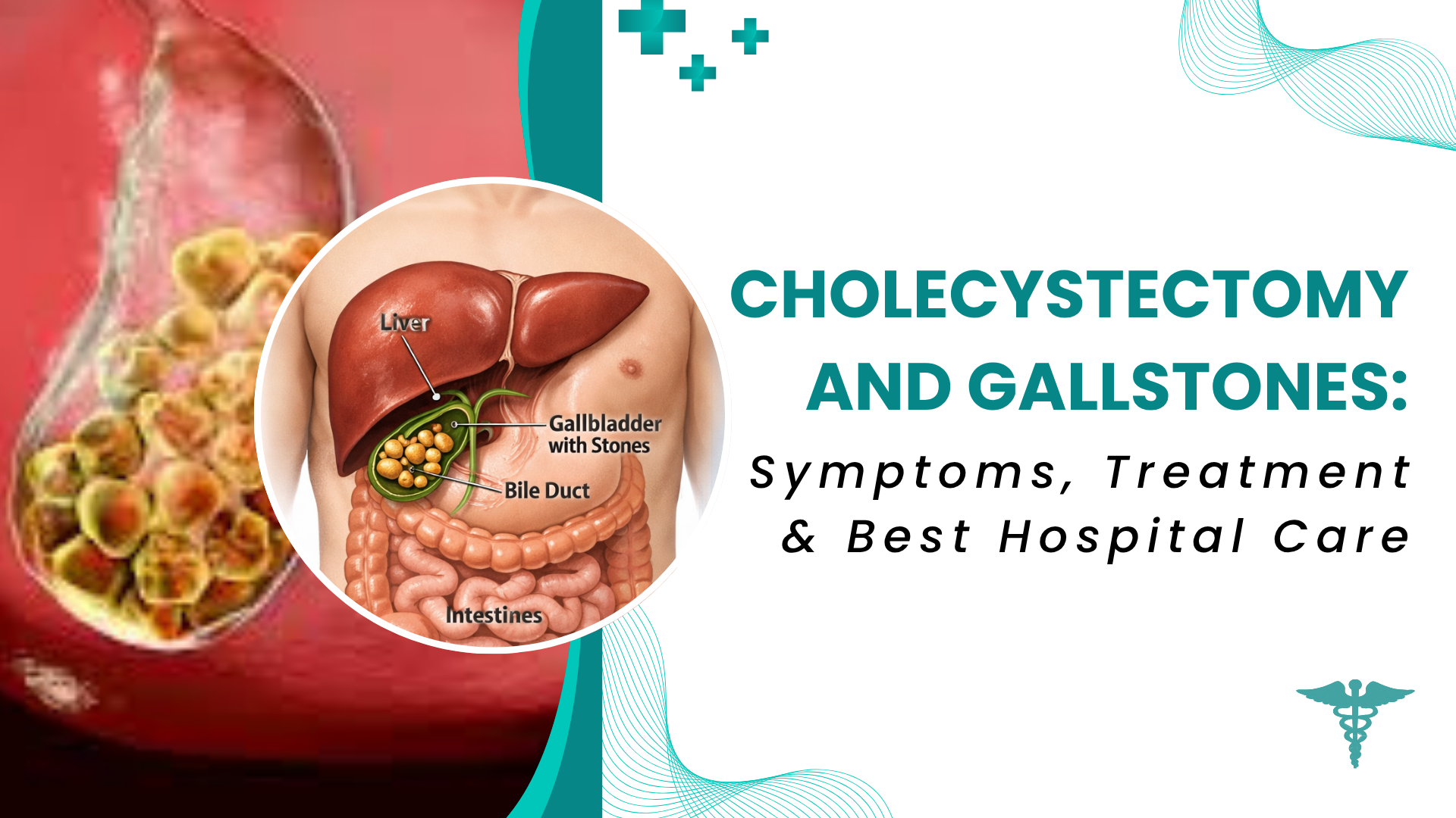 Cholecystectomy and gallstones infographic showing gallbladder with stones, symptoms, and treatment overview.